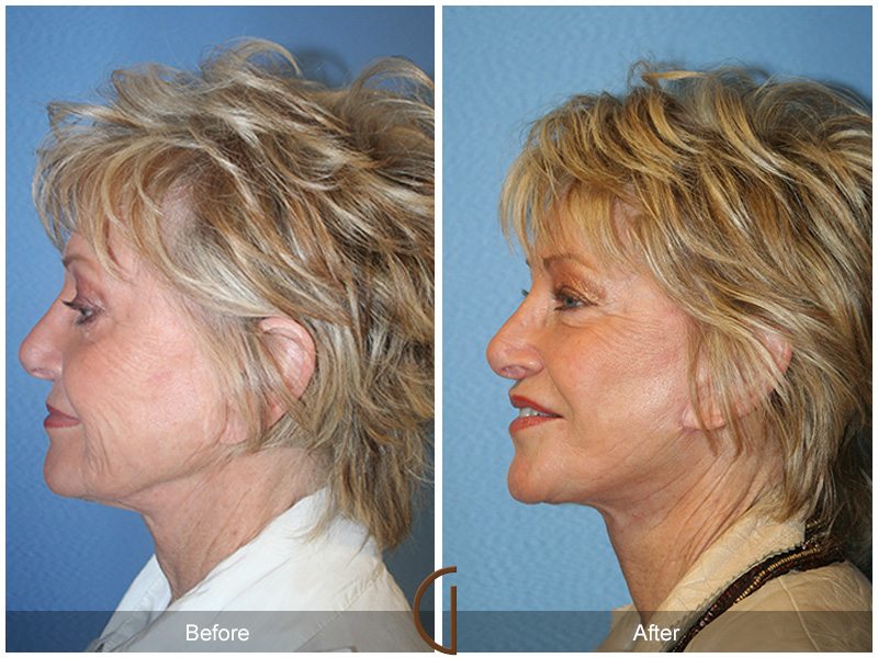 Female Facelift  Before & After Image