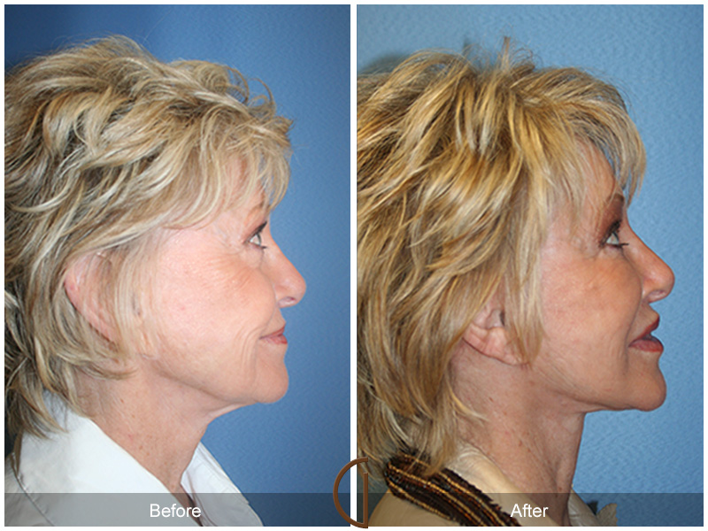 Female Facelift  Before & After Image