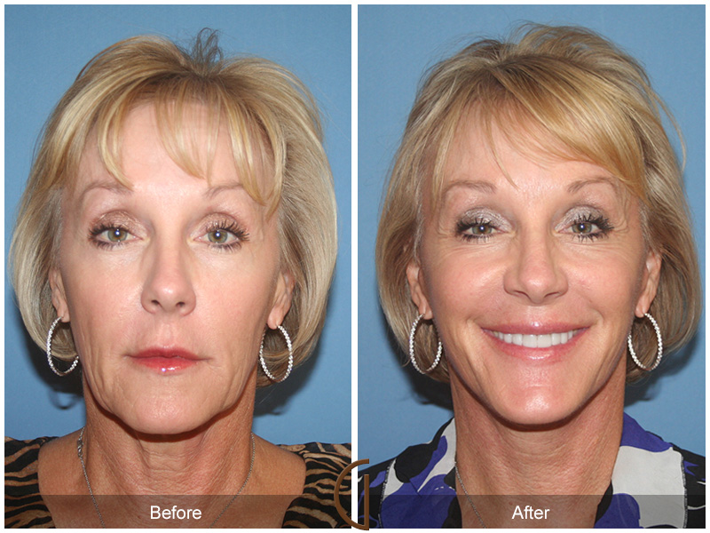 Female Facelift  Before & After Image