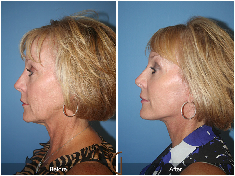 Female Facelift  Before & After Image