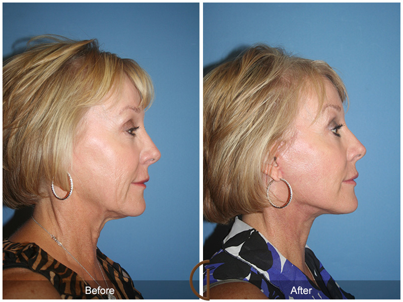 Female Facelift  Before & After Image