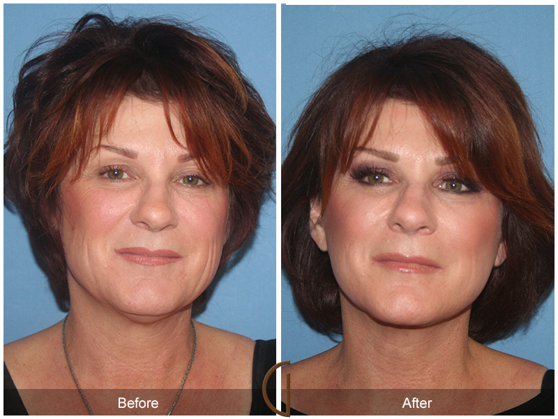 Female Facelift  Before & After Image