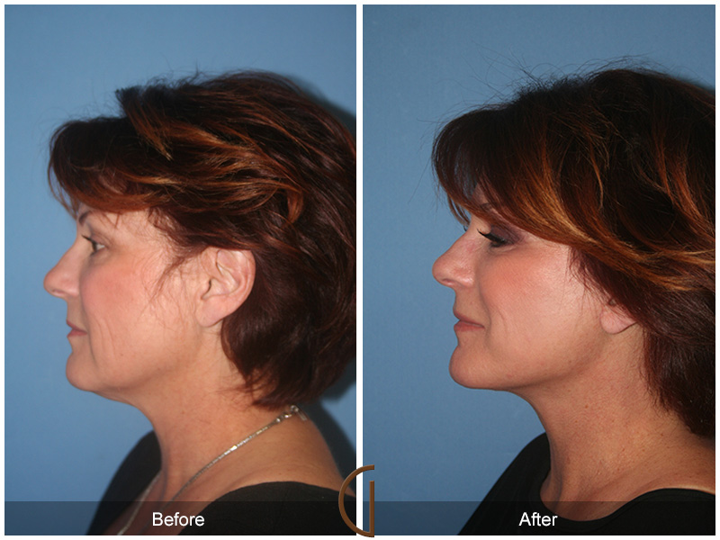 Female Facelift  Before & After Image