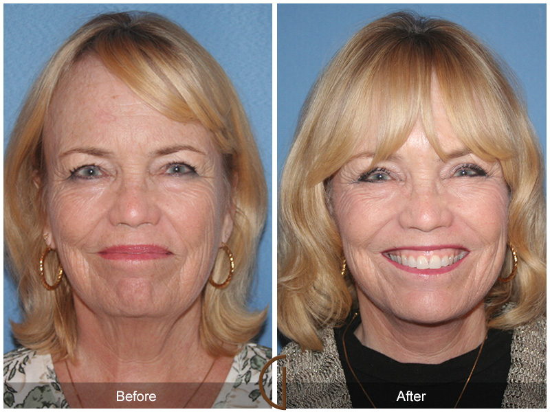 Female Facelift  Before & After Image