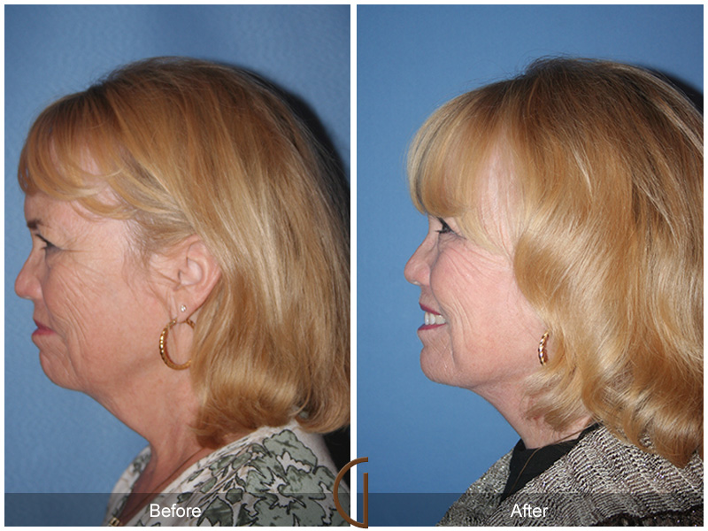 Female Facelift  Before & After Image