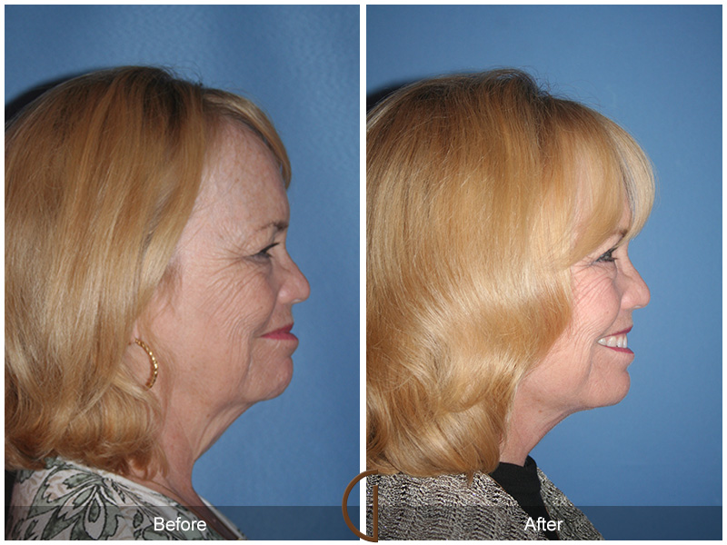 Female Facelift  Before & After Image