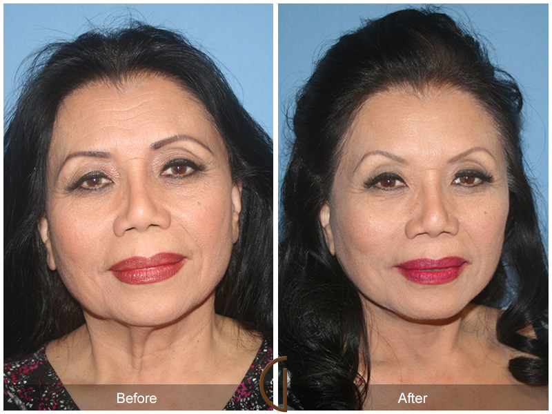 Female Facelift  Before & After Image