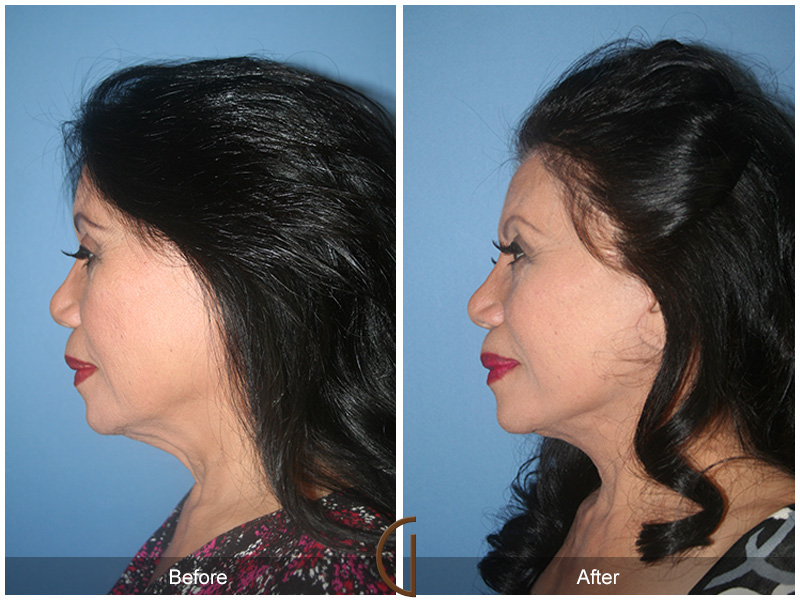 Female Facelift  Before & After Image