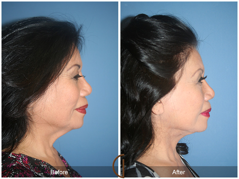 Female Facelift  Before & After Image