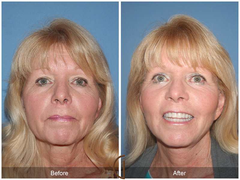 Female Facelift  Before & After Image