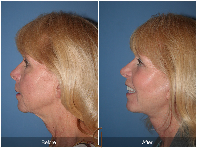 Female Facelift  Before & After Image