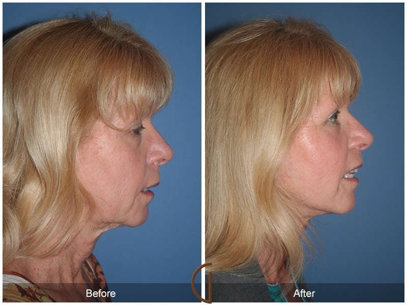 Female Facelift  Before & After Image