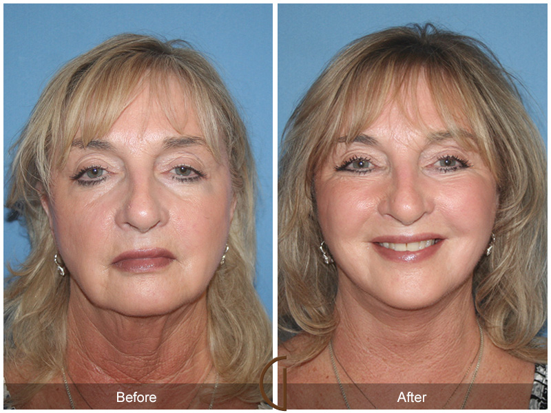 Female Facelift  Before & After Image