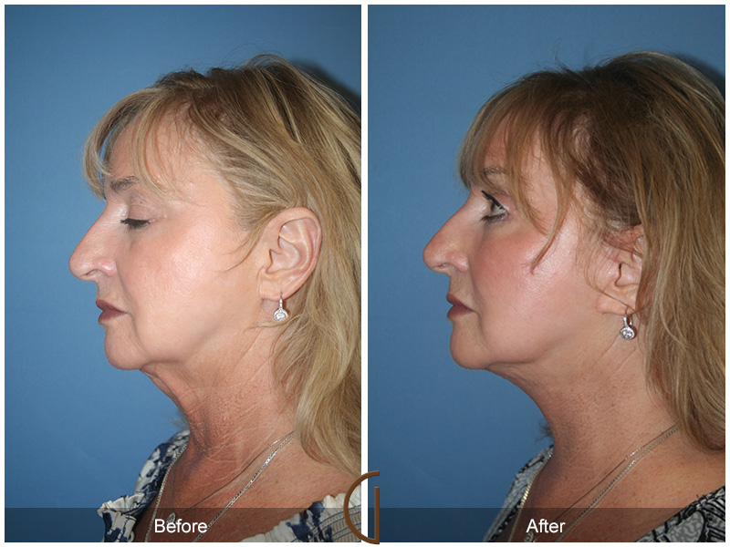 Female Facelift  Before & After Image