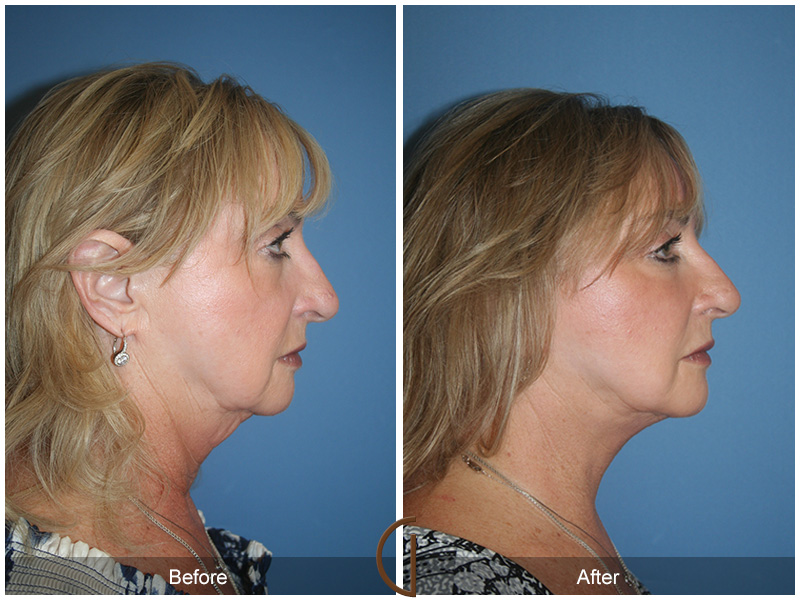 Female Facelift  Before & After Image