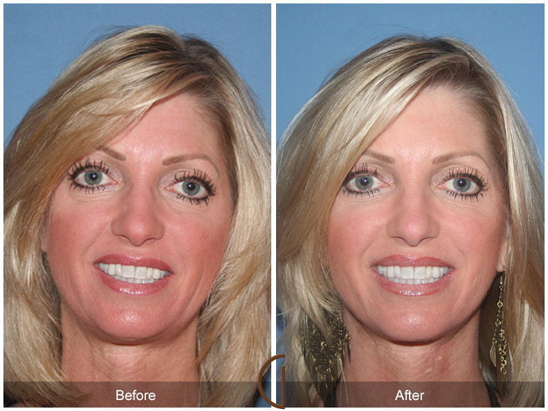 Female Facelift  Before & After Image