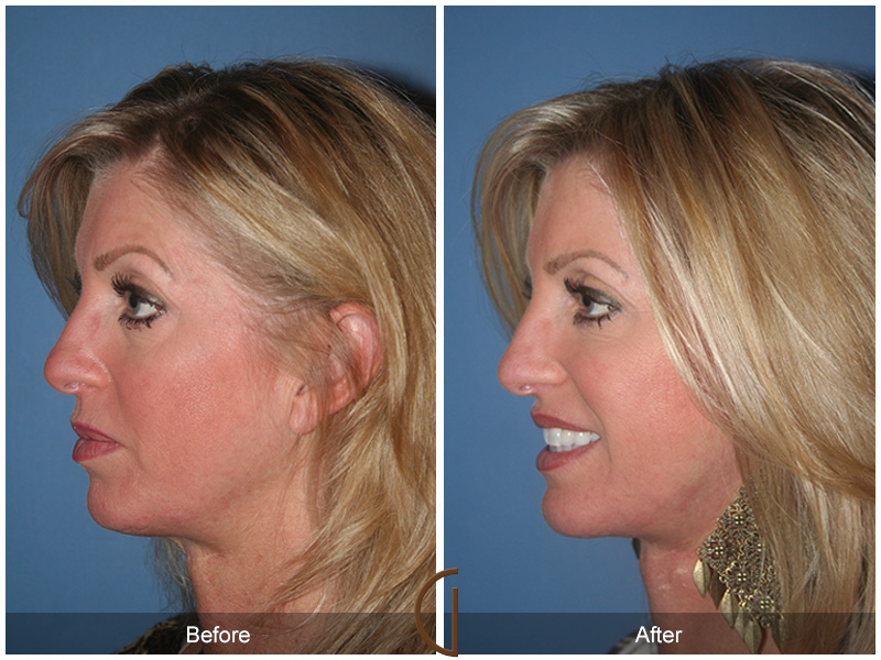 Female Facelift  Before & After Image