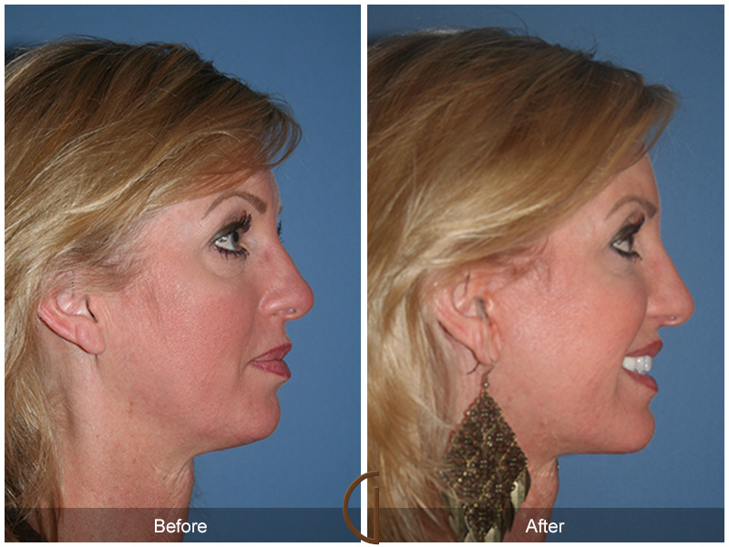 Female Facelift  Before & After Image