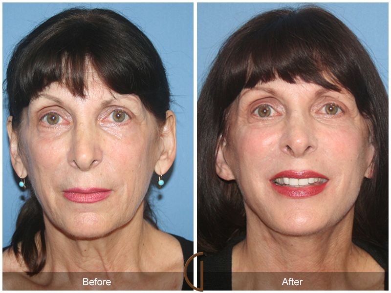 Female Facelift  Before & After Image