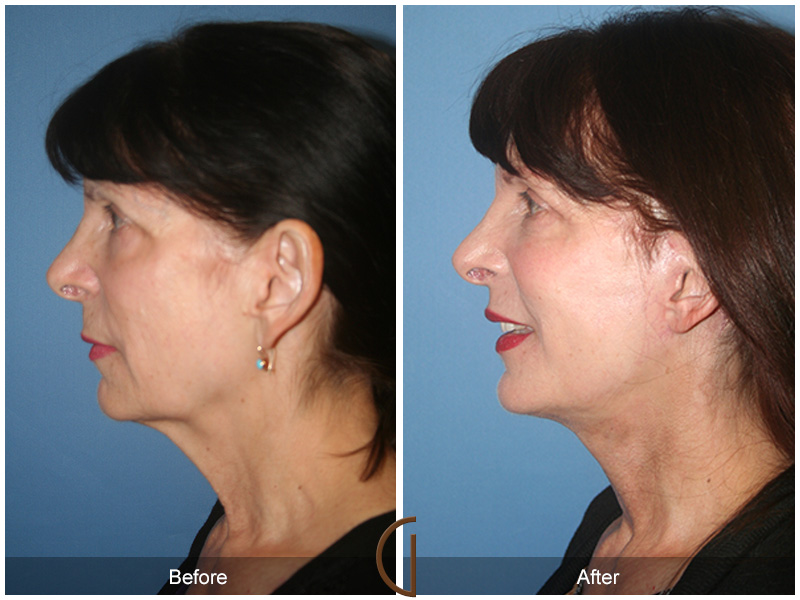 Female Facelift  Before & After Image