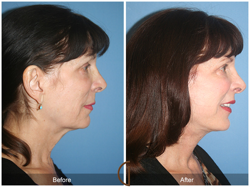 Female Facelift  Before & After Image