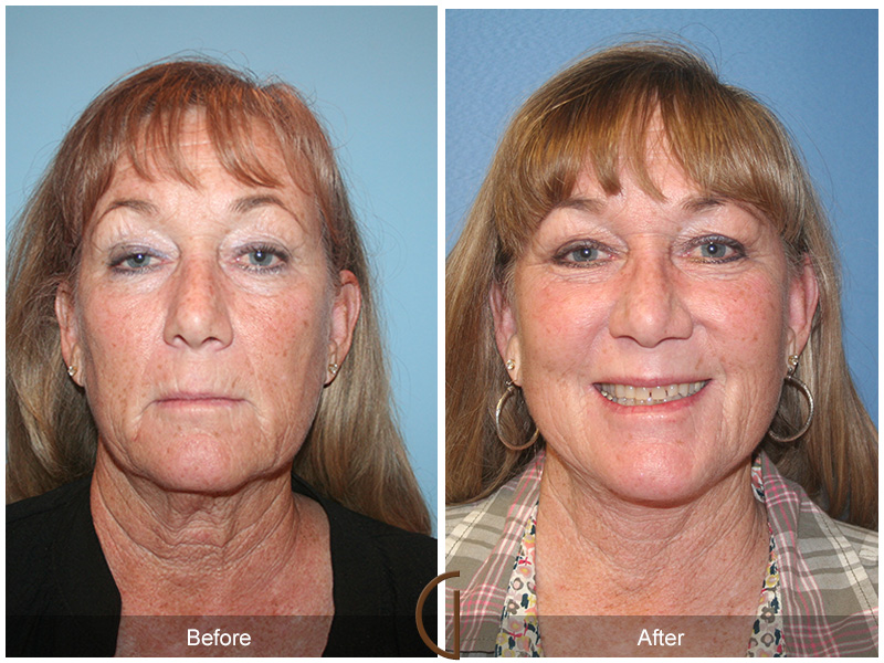 Female Facelift  Before & After Image