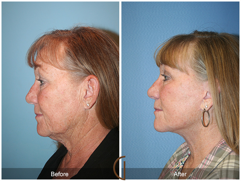 Female Facelift  Before & After Image