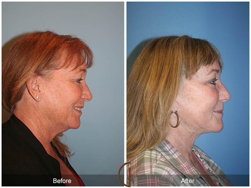 Female Facelift  Before & After Image