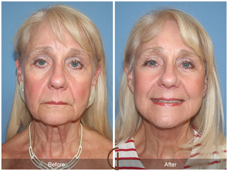 Female Facelift  Before & After Image