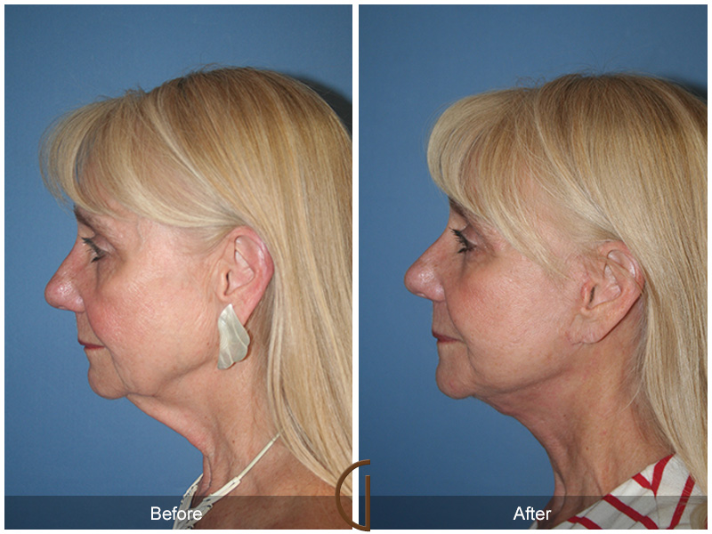 Female Facelift  Before & After Image