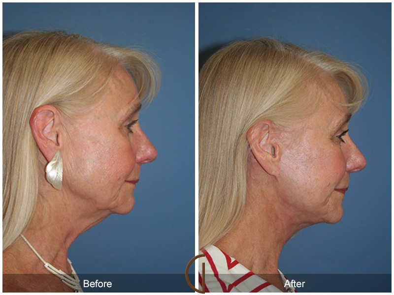 Female Facelift  Before & After Image