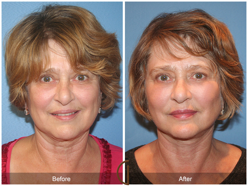 Female Facelift  Before & After Image