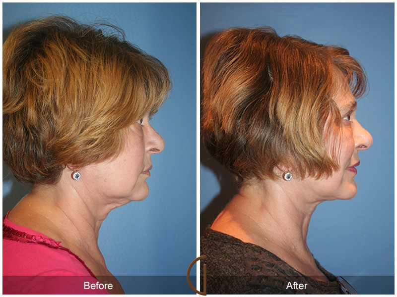 Female Facelift  Before & After Image