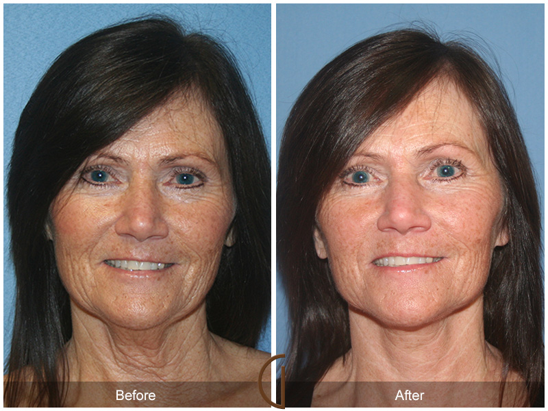 Female Facelift  Before & After Image