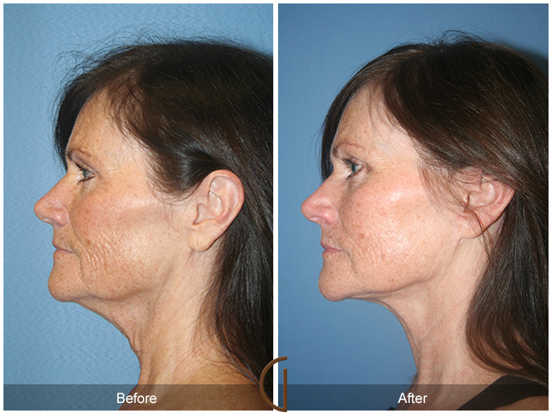 Female Facelift  Before & After Image