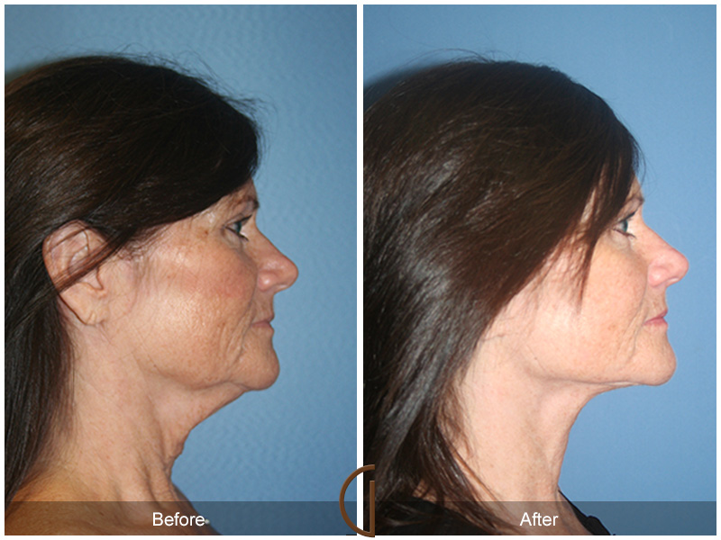 Female Facelift  Before & After Image