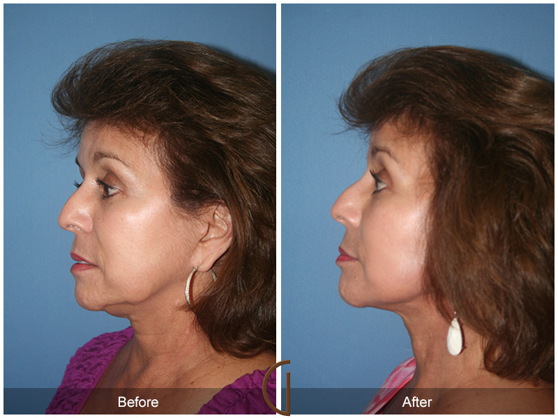 Female Facelift  Before & After Image