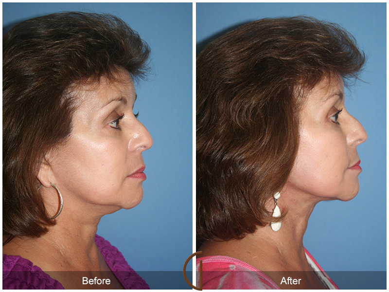 Female Facelift  Before & After Image