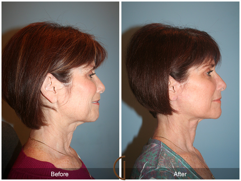 Female Facelift  Before & After Image