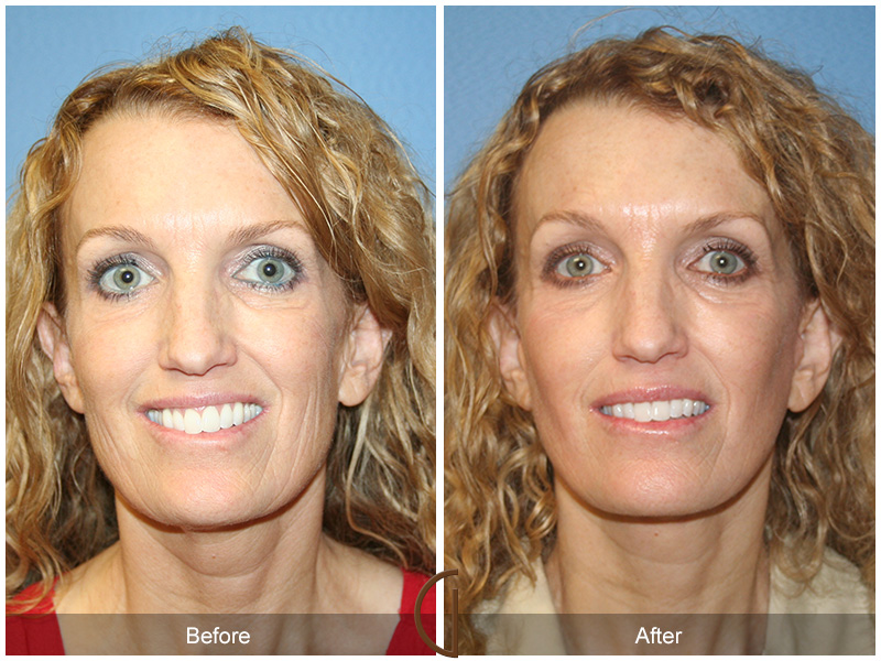 Female Facelift  Before & After Image