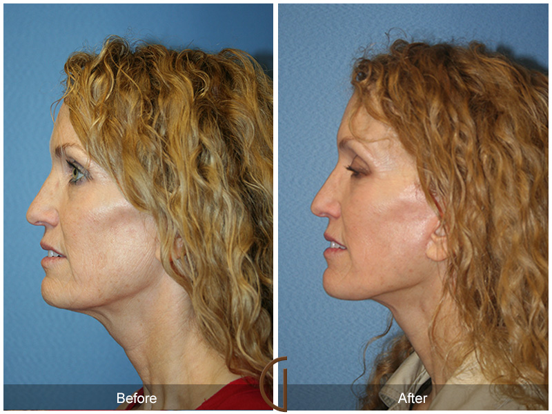 Female Facelift  Before & After Image