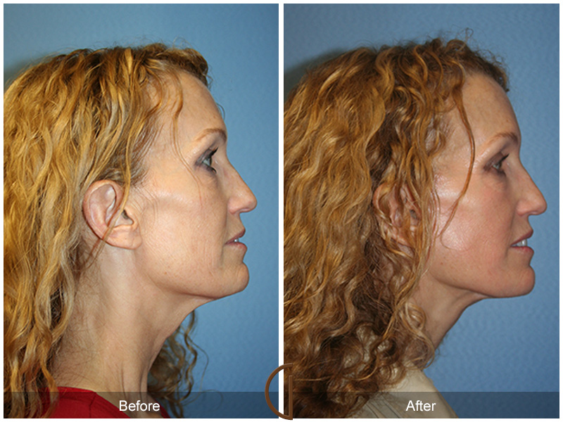 Female Facelift  Before & After Image