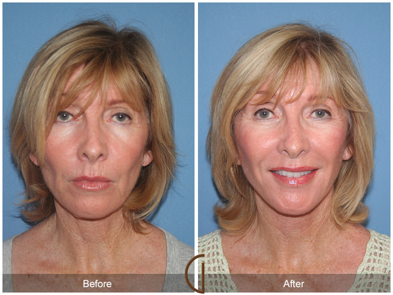 Female Facelift  Before & After Image