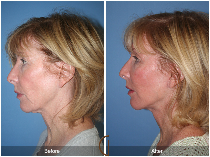 Female Facelift  Before & After Image