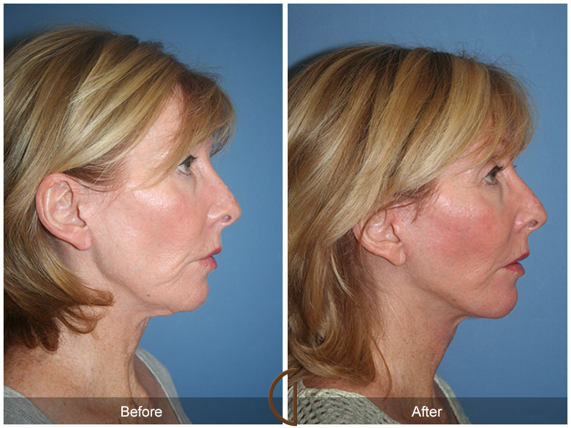 Female Facelift  Before & After Image