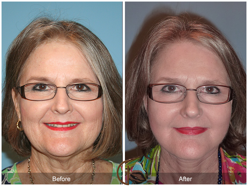 Female Facelift  Before & After Image