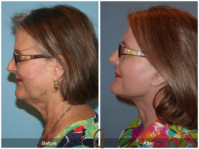 Female Facelift  Before & After Image