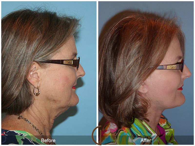 Female Facelift  Before & After Image