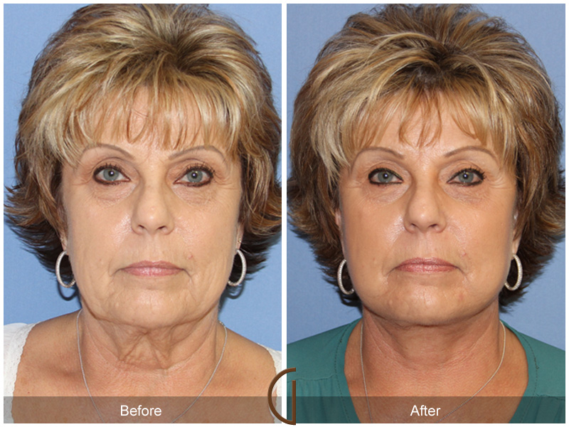 Laser Procedures Before & After Image