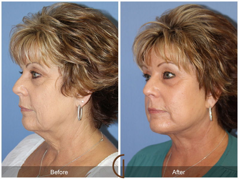 Laser Procedures Before & After Image